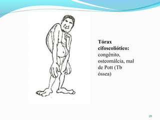 20
Tórax
cifoscoliótico:
congênito,
osteomálcia, mal
de Pott (Tb
óssea)
 