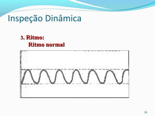 Inspeção Dinâmica
24
33. Ritmo:. Ritmo:
Ritmo normalRitmo normal
 