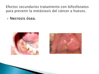 Necrosis ósea.Efectos secundarios tratamiento con bifosfonatos para prevenir la metástasis del cáncer a huesos.