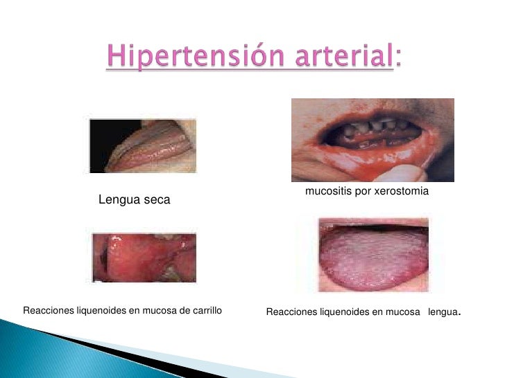 Preguntas sobre medicamentos para hipertensión