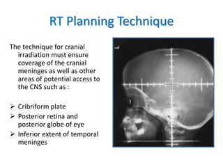 RT Planning Technique
The technique for cranial
irradiation must ensure
coverage of the cranial
meninges as well as other
areas of potential access to
the CNS such as :
 Cribriform plate
 Posterior retina and
posterior globe of eye
 Inferior extent of temporal
meninges
 