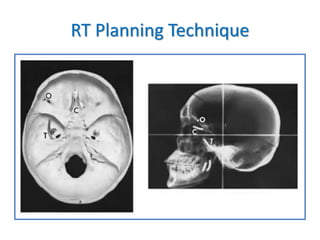 RT Planning Technique
 