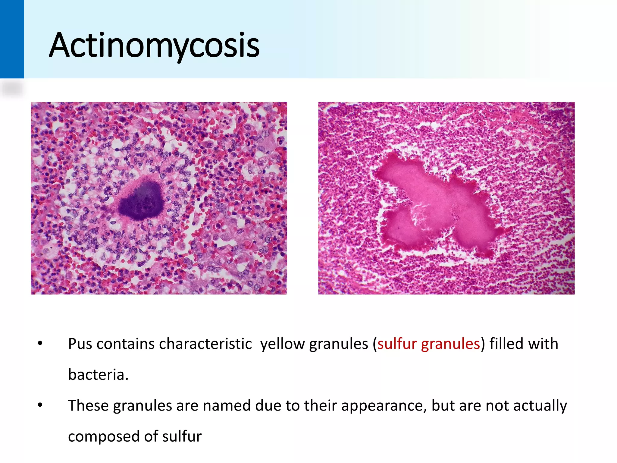 Propionibacterium, Actinomyces and Nocardia | PDF