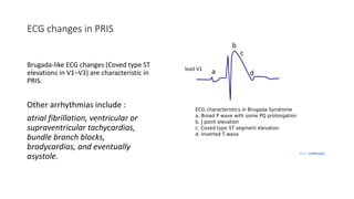 ECG changes in PRIS
Brugada-like ECG changes (Coved type ST
elevations in V1–V3) are characteristic in
PRIS.
Other arrhythmias include :
atrial fibrillation, ventricular or
supraventricular tachycardias,
bundle branch blocks,
bradycardias, and eventually
asystole.
 