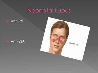 Neonatal LupusAnti-RoAnti-SSA