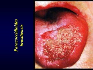 71Paracoccidioidesbrasiliensis