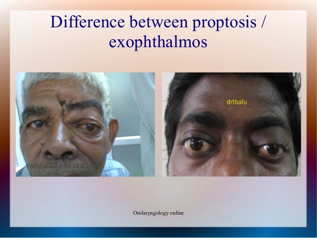 proptosis proptosis