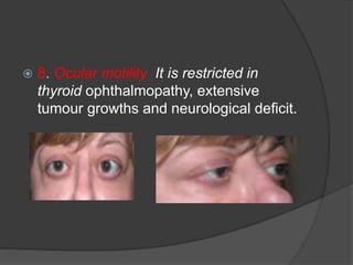  8. Ocular motility It is restricted in 
thyroid ophthalmopathy, extensive 
tumour growths and neurological deficit. 
 
