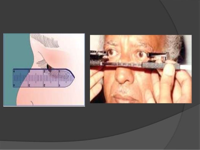 2 eye jones test Proptosis 2 eye jones test Proptosis