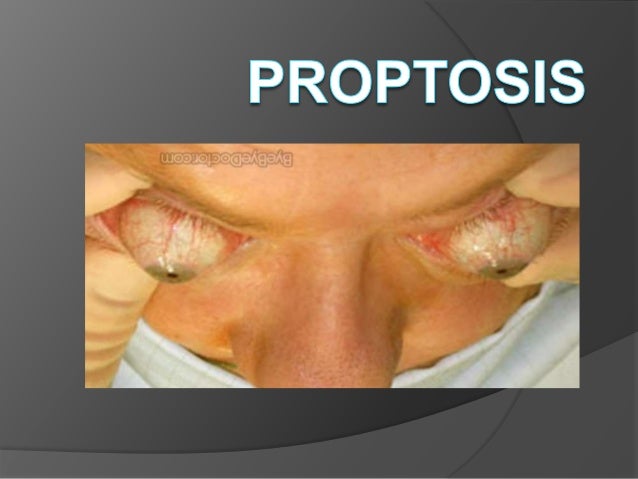 Serene Proptosis Of Eye Artwork Digital Art Serene Proptosis Of Eye Artwork Digital Art