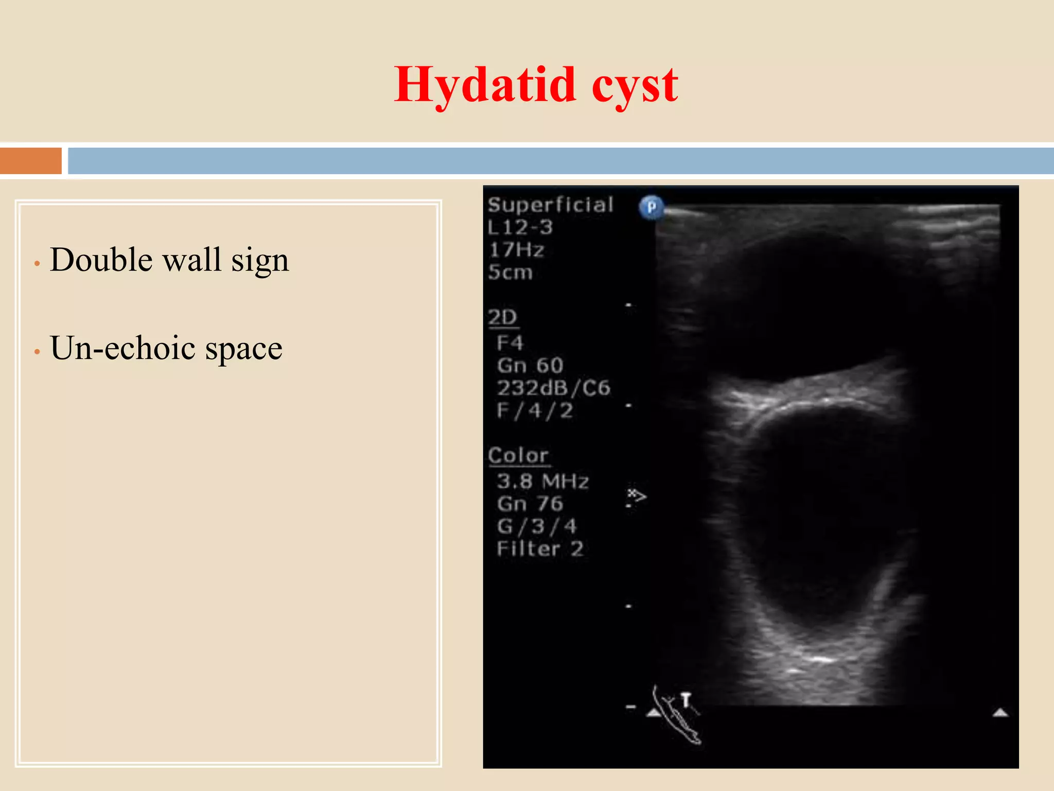Hydatid cyst
• Double wall sign
• Un-echoic space
 