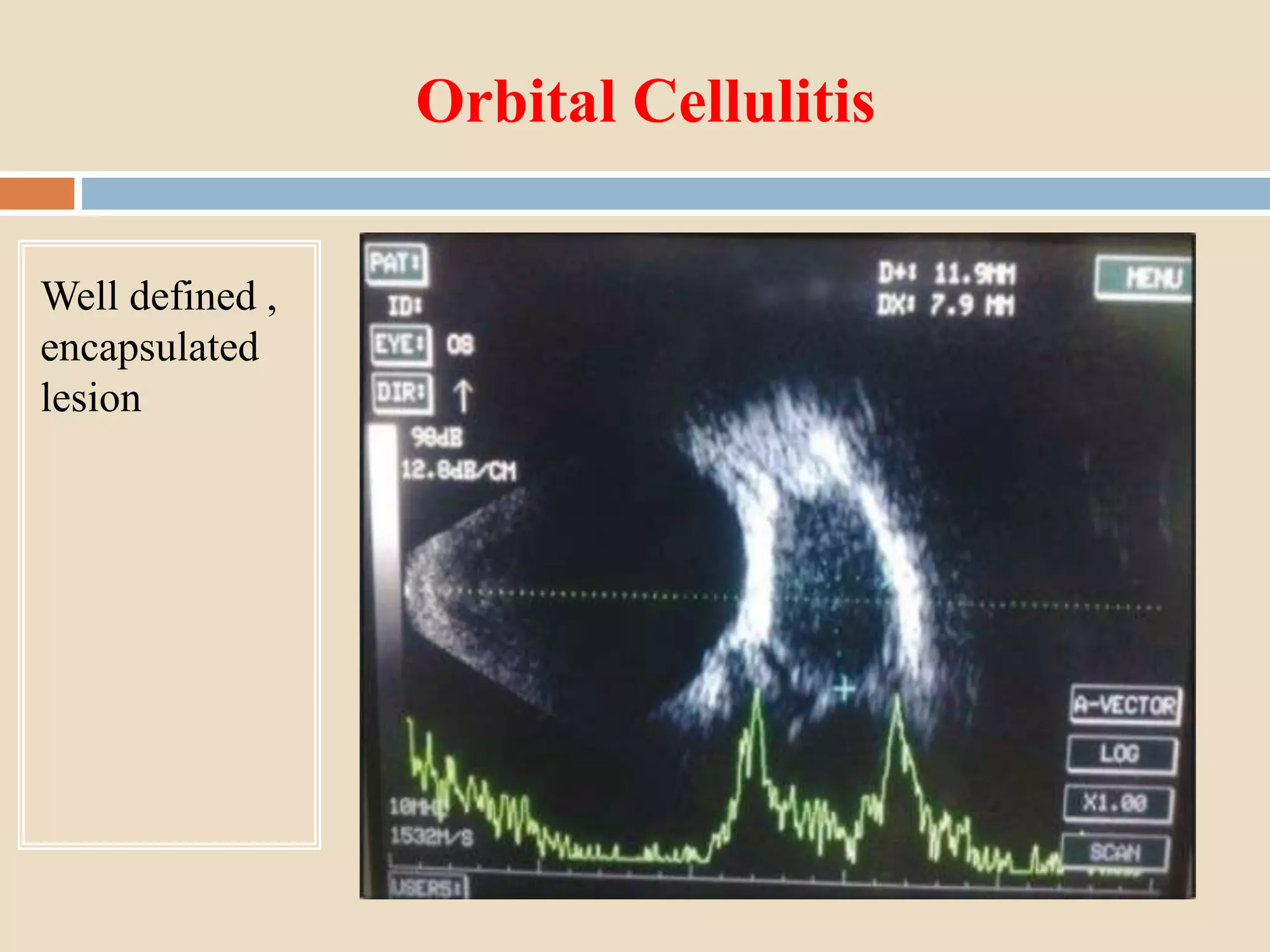 Orbital Cellulitis
Well defined ,
encapsulated
lesion
 