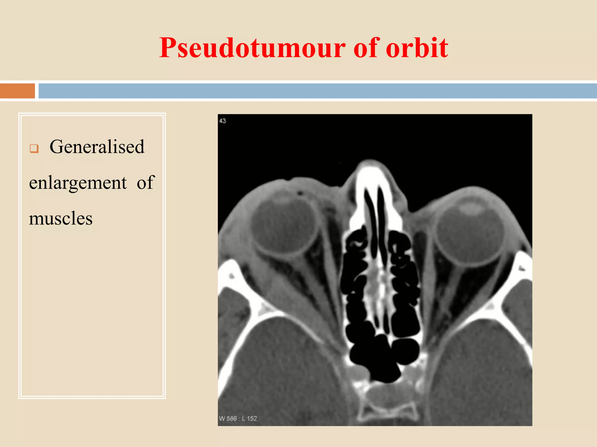 Pseudotumour of orbit
 Generalised
enlargement of
muscles
 