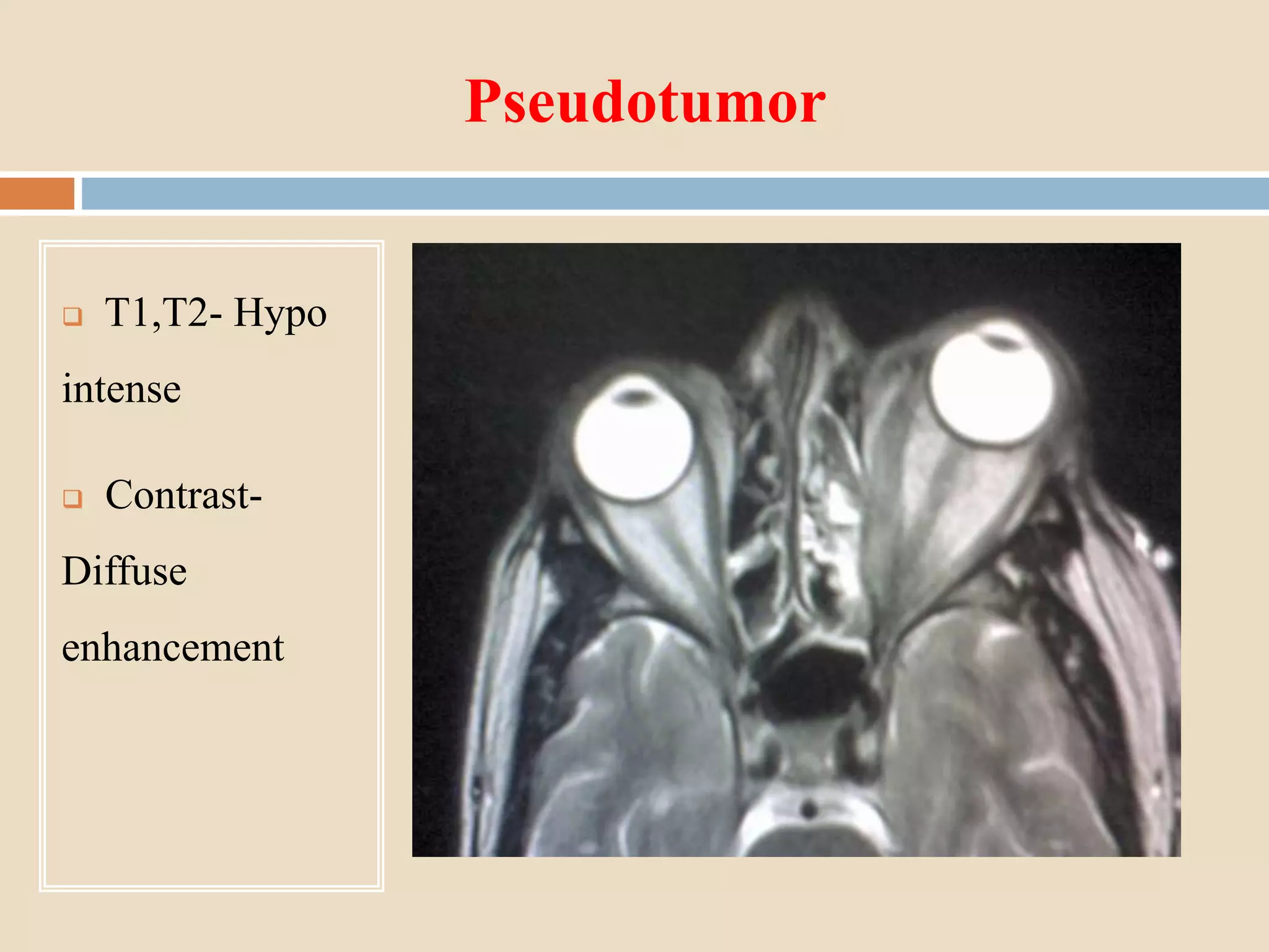 Pseudotumor
 T1,T2- Hypo
intense
 Contrast-
Diffuse
enhancement
 