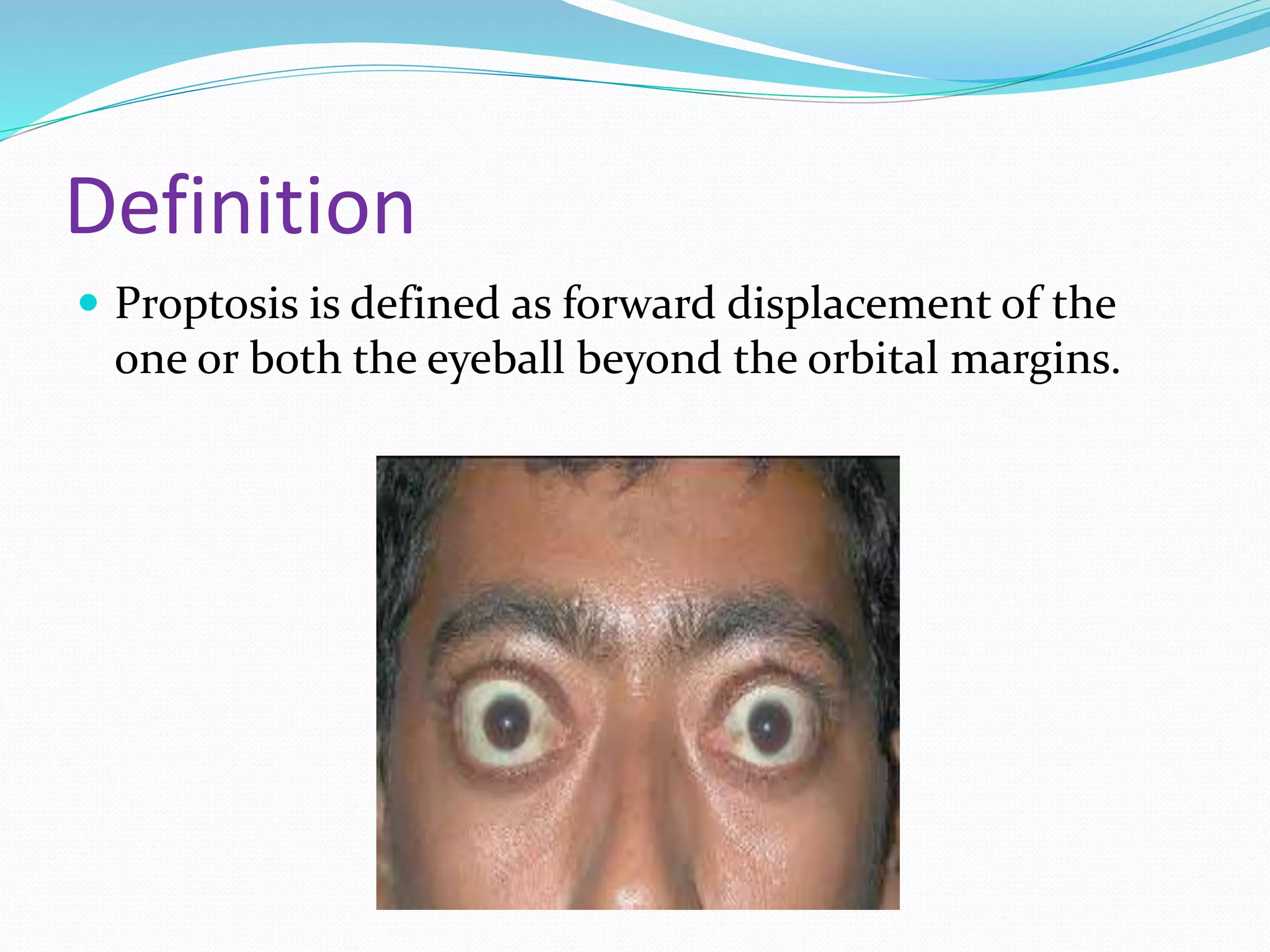 Crisp Proptosis Of Eye Image Photography Crisp Proptosis Of Eye Image Photography