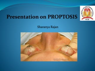 Presentation on PROPTOSIS
Sharanya Rajan
 