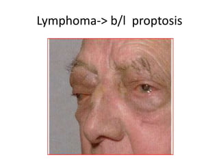 Lymphoma-> b/l proptosis
 