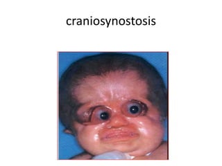 craniosynostosis
 