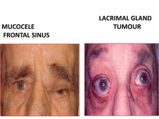 LACRIMAL GLAND
MUCOCELE TUMOUR
FRONTAL SINUS
 