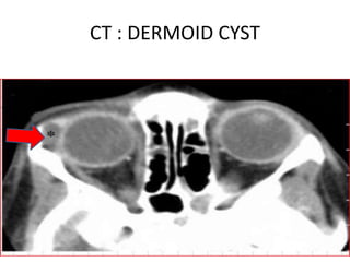 CT : DERMOID CYST
 