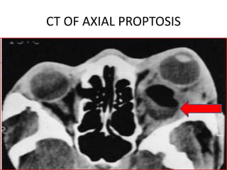 CT OF AXIAL PROPTOSIS
 