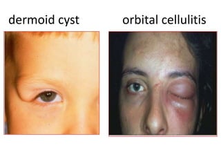 dermoid cyst orbital cellulitis
 