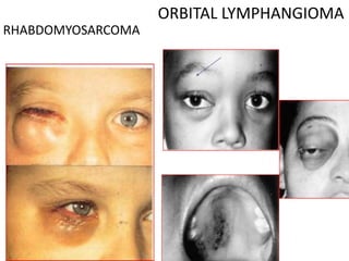 RHABDOMYOSARCOMA
ORBITAL LYMPHANGIOMA
 