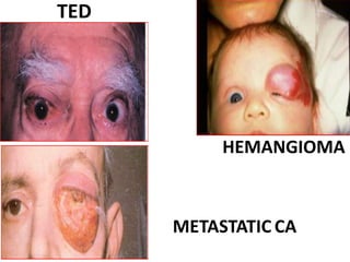 TED
HEMANGIOMA
METASTATIC CA
 