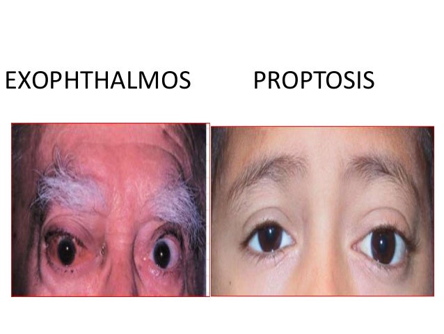 proptosis in ophthalmology proptosis