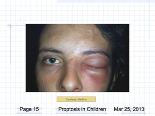 Courtesy: Medline



Page 15   Proptosis in Children   Mar 25, 2013
 