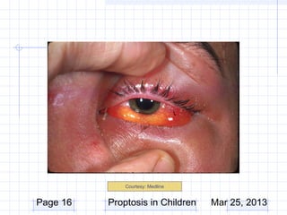 Courtesy: Medline


Page 16   Proptosis in Children   Mar 25, 2013
 