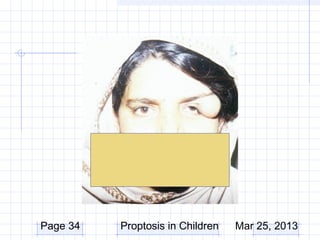 Page 34   Proptosis in Children   Mar 25, 2013
 