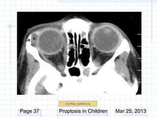 Courtesy: eyetext.org


Page 37   Proptosis in Children     Mar 25, 2013
 