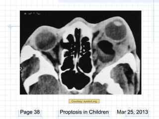 Courtesy: eyetext.org



Page 38   Proptosis in Children        Mar 25, 2013
 