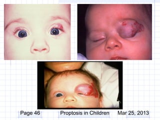 Page 46   Proptosis in Children   Mar 25, 2013
 