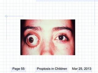 Page 55   Proptosis in Children   Mar 25, 2013
 