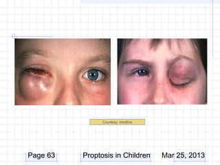 Courtesy: medline




Page 63   Proptosis in Children     Mar 25, 2013
 