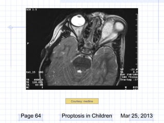 Courtesy: medline




Page 64   Proptosis in Children   Mar 25, 2013
 