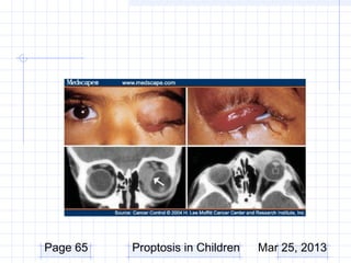 Page 65   Proptosis in Children   Mar 25, 2013
 