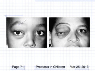 Page 71   Proptosis in Children   Mar 25, 2013
 