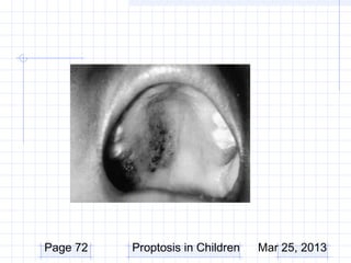 Page 72   Proptosis in Children   Mar 25, 2013
 