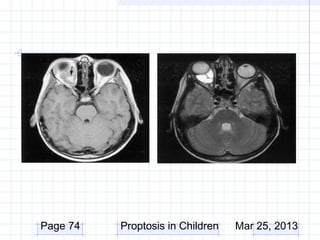 Page 74   Proptosis in Children   Mar 25, 2013
 