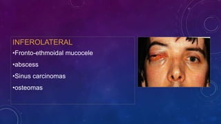 INFEROLATERAL
•Fronto-ethmoidal mucocele
•abscess
•Sinus carcinomas
•osteomas
 