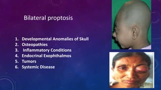 1. Developmental Anomalies of Skull
2. Osteopathies
3. Inflammatory Conditions
4. Endocrinal Exophthalmos
5. Tumors
6. Systemic Disease
Bilateral proptosis
 