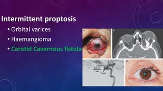 Intermittent proptosis
• Orbital varices
• Haemangioma
• Carotid Cavernous fistula
 
