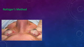 Nafziger’s Method
 