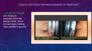 CLINICAL METHODS FOR MEASUREMENT OF PROPTOSIS:
A) PLASTIC RULER:
can measure
proptosis from the
lateral orbital rim to
corneal apex,holding
ruler parallel to ground
 