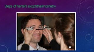 Steps of hertel’s exophthalmometry
 
