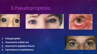 3.Pseudoproptosis
1. Enlarged globe
2. Asymmetric orbital size
3. Asymmetric palpebral fissure
4. Contralateral enophthalmos
 