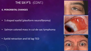 THE SIX P’S (CONT.)
6. PERIORBITAL CHANGES
• S shaped eyelid (plexiform neurofibroma)
• Salmon colored mass in cul-de-sac-lymphoma
• Eyelid retraction and lid lag-TED
 